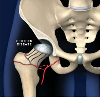 Perthes hip with the blood supply cut off to the femoral head