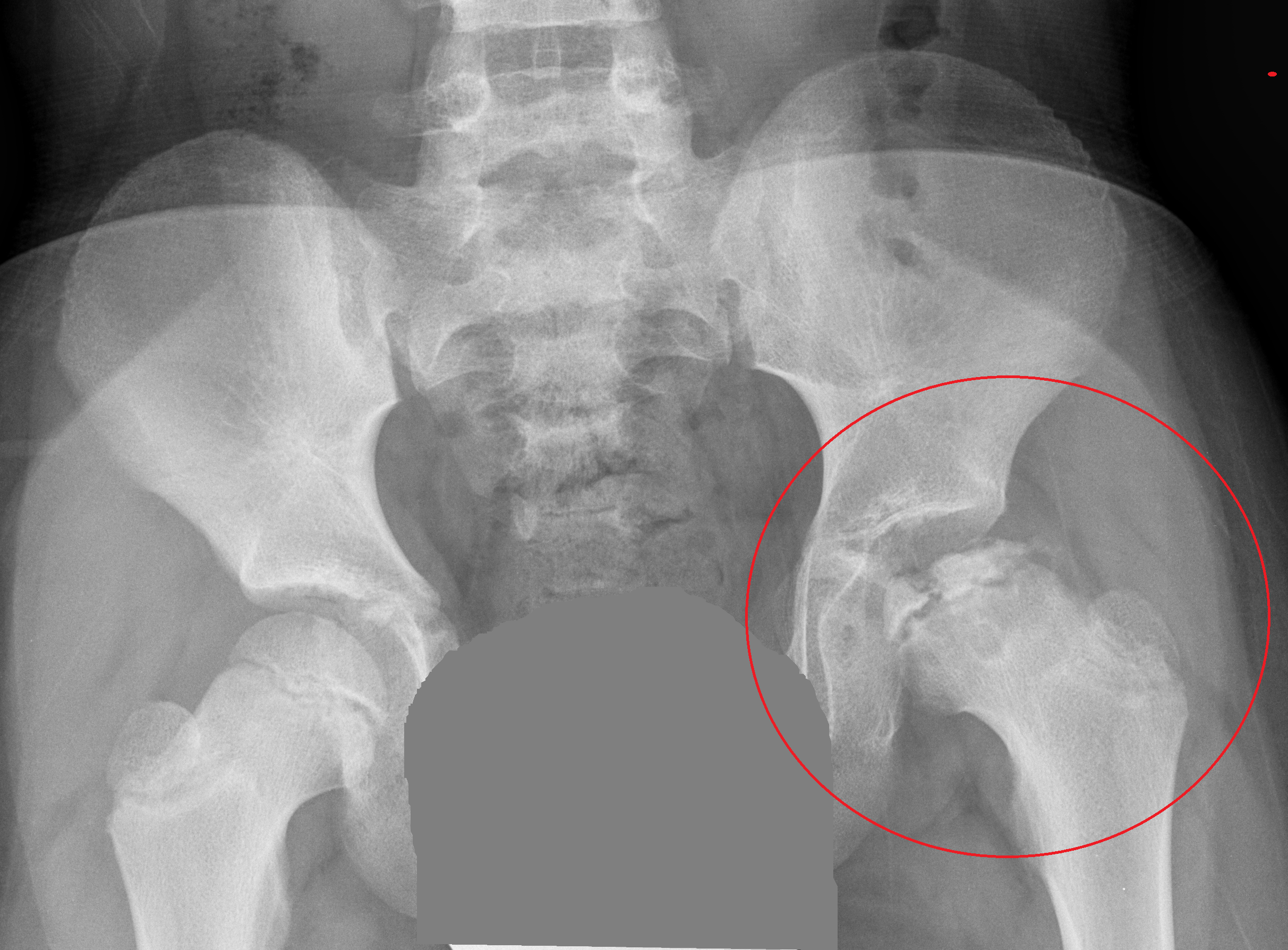 Pelvic X-ray showing Legg-Calvé-Perthes disease, with the affected left hip circled in red